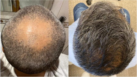 Crown hair transplant before and after