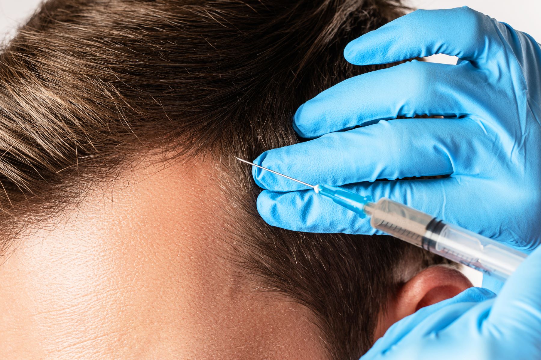 PRP hair treatment for alopecia areata