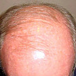 androgenetic alopecia