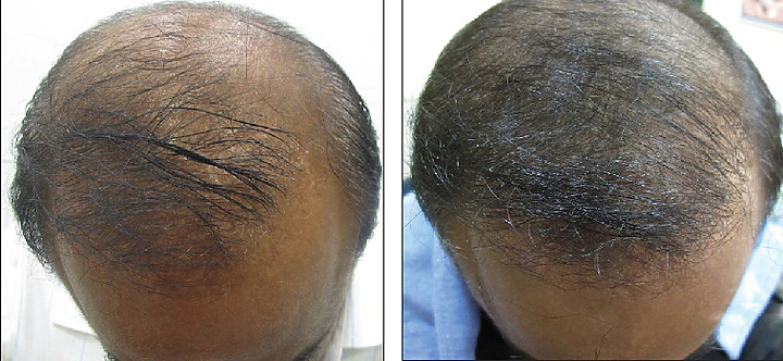 30-year-old patient with Norwood stage 5 hair loss before and after six months of microneedling