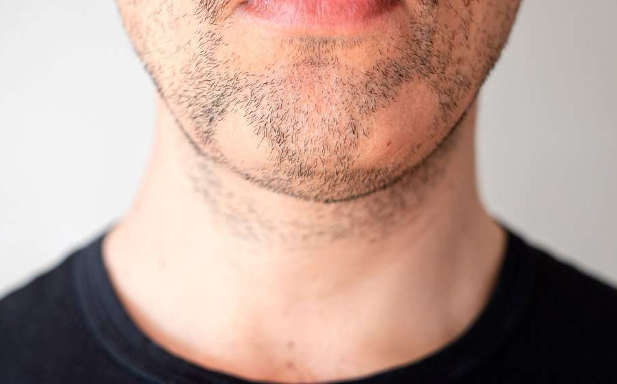 7 Reasons You May Be Growing A Patchy Beard And How To Fix It