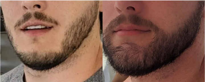 A male patient’s beard before and 8 months after a FUE beard transplant