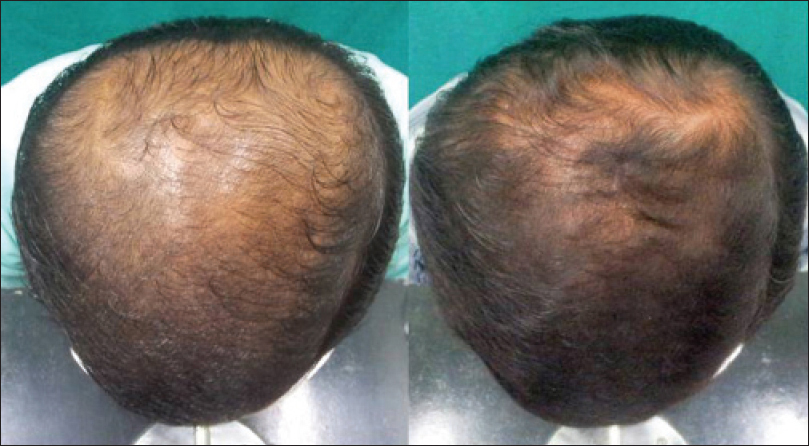 A male pattern baldness patient pre-treatment and after 24 weeks of Dutasteride use