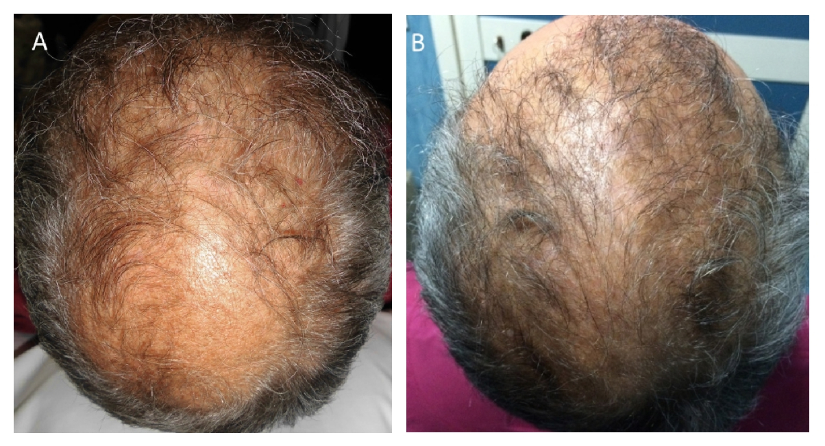 A nonsmoker 52-year-old male patient affected by hair loss
