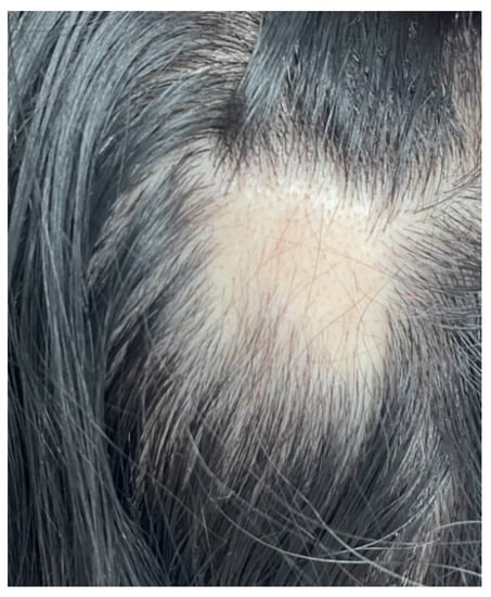 Alopecia areata due to Hashimoto thyroiditis