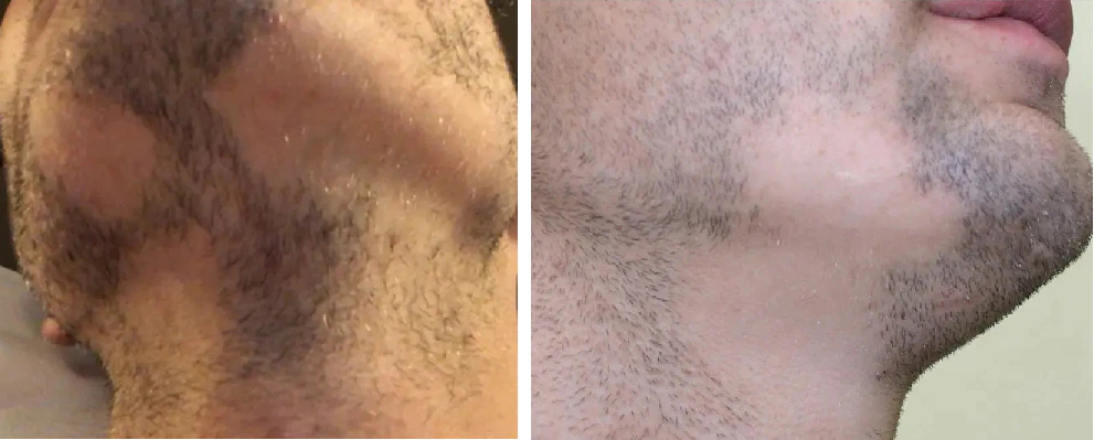Alopecia barbae in two male patients