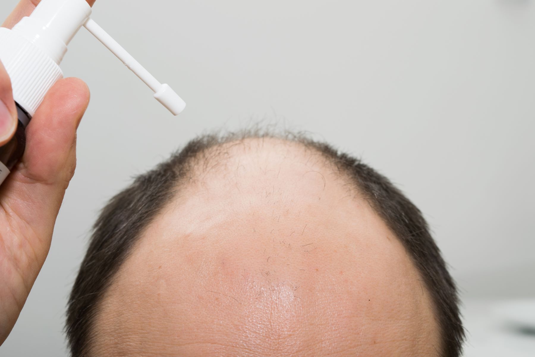 Alopecia treatment