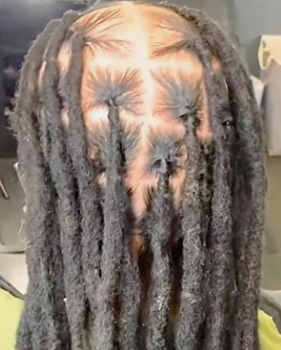 Bald spot with dreadlocks