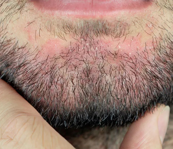 Beard seborrheic dermatitis