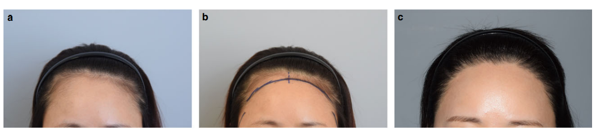 Before and after 1.5 cm FUE hairline lowering (1280 grafts)