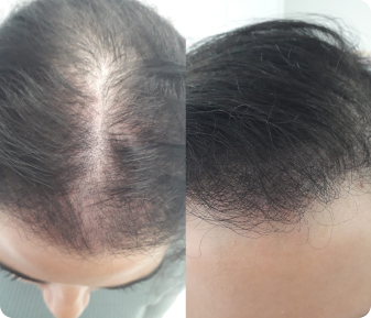 Before and after hair tattoo results fuller density