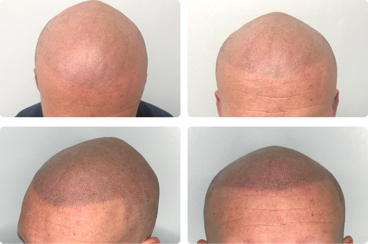 Before and after hair tattoo results on bald head