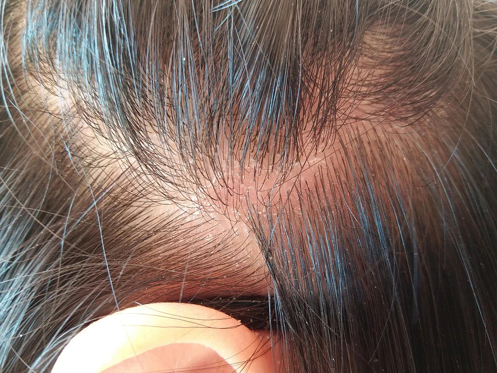 Close-up image of a dry, flaky scalp