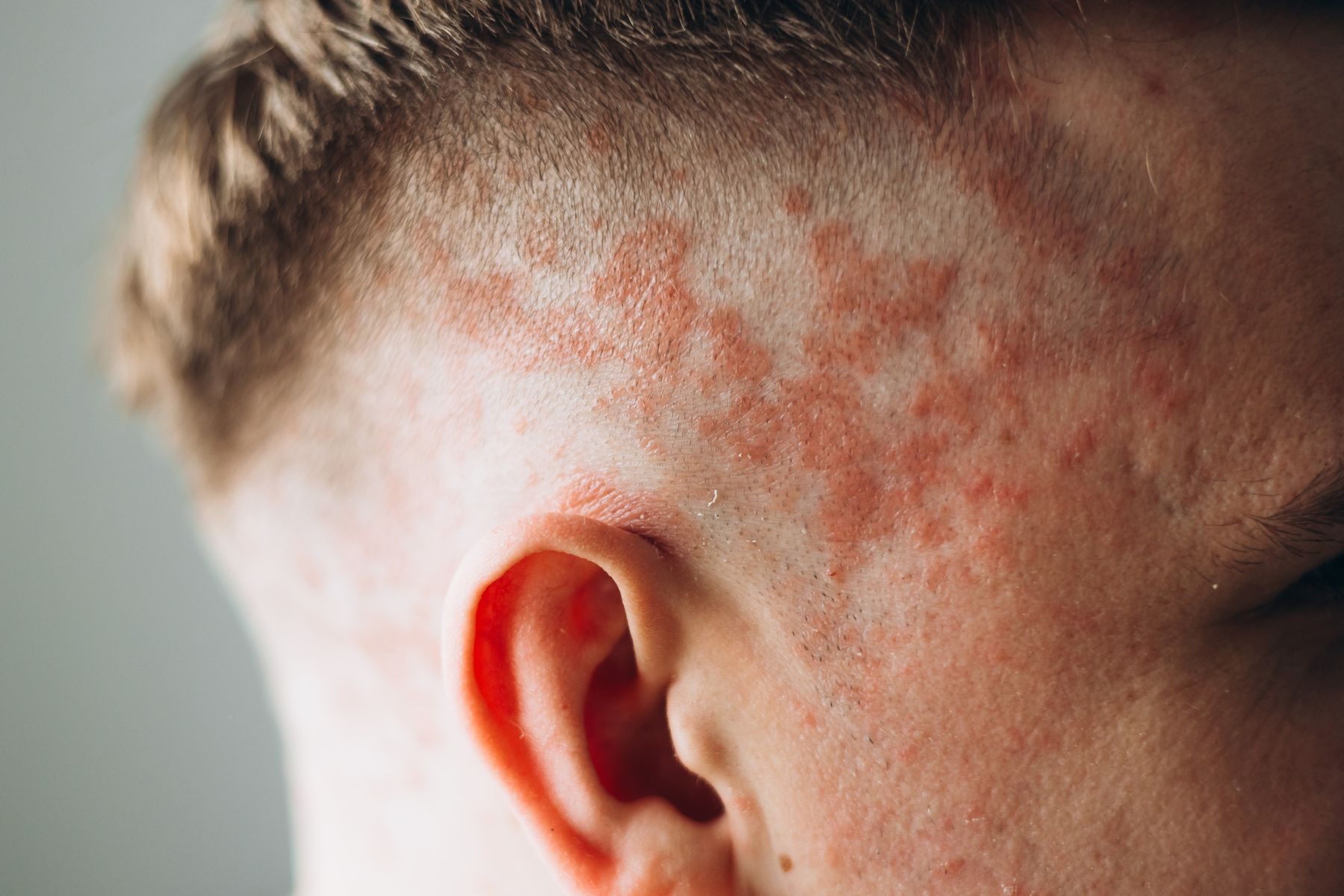 Dermatological condition of the scalp (psoriasis)