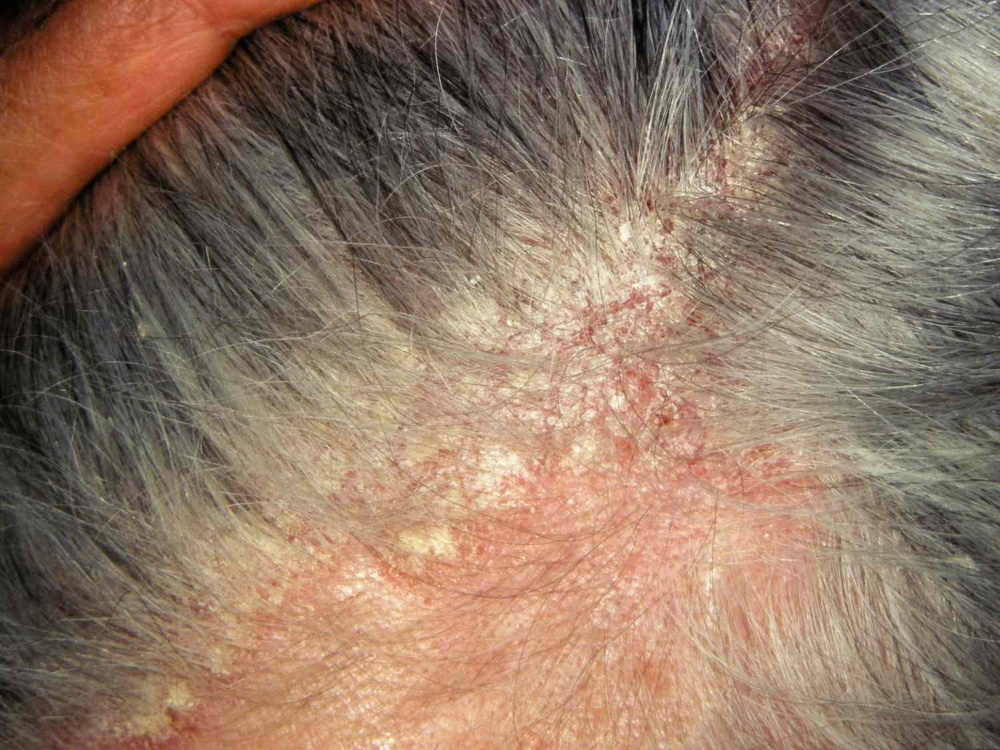 Dermatological condition of the scalp (psoriasis)