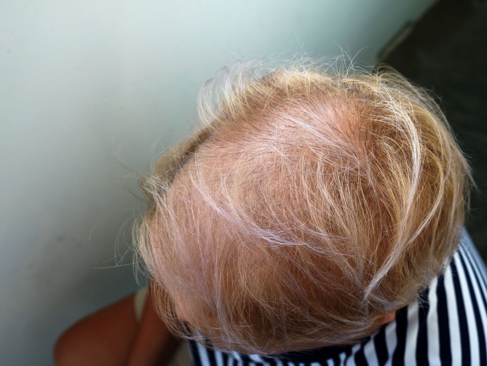 Diffuse thinning in female pattern baldness