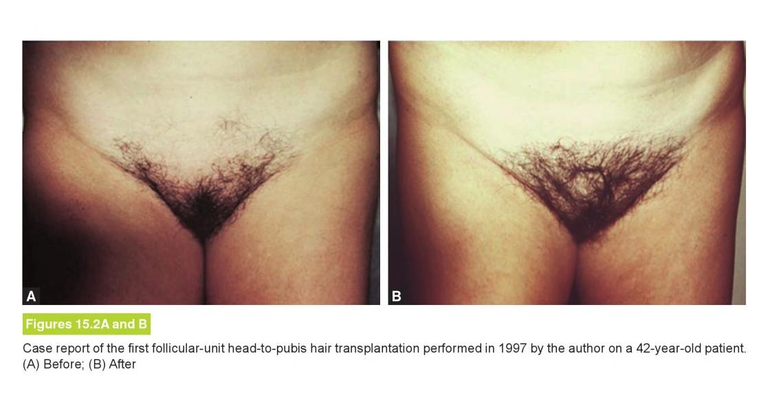 Example of a pubic hair transplant