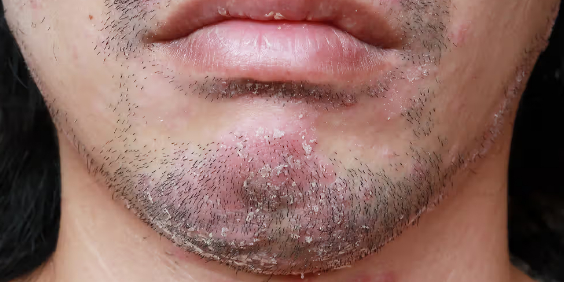Facial psoriasis localised in the beard