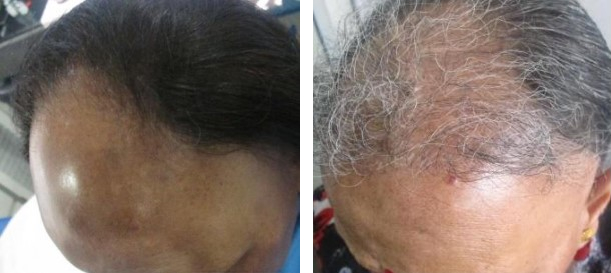 Female patient before and 8 months after a 2000 graft FUE hair transplant followed by PRP therapy