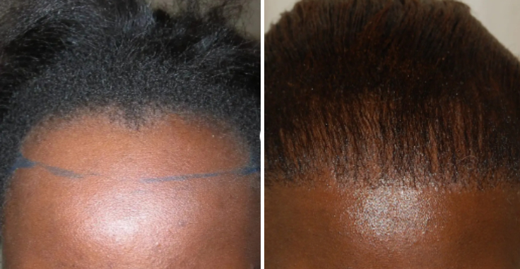 Female patient before and after a forehead hair transplant