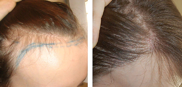 Female patient before and after an FUT hair transplant