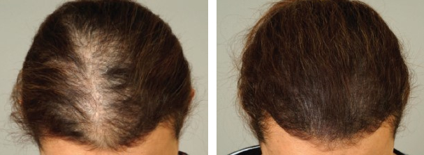 Female patient before and after scalp micropigmentation