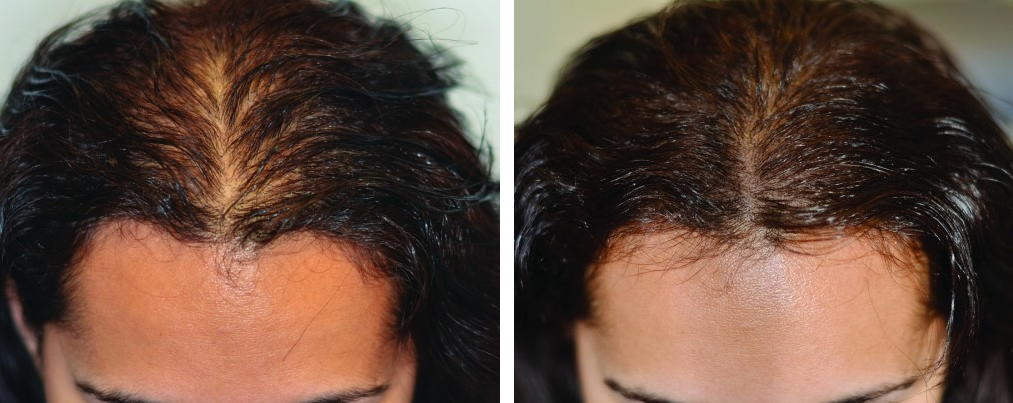 Female patient with androgenetic alopecia before and after scalp micropigmentation
