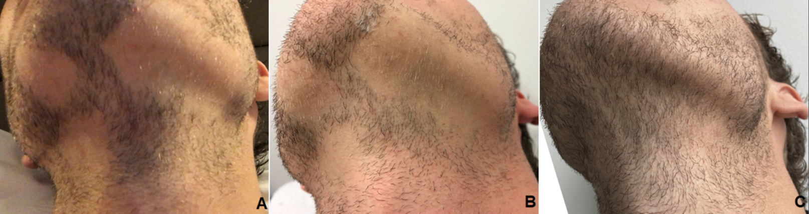 Hair regrowth after PRP treatment