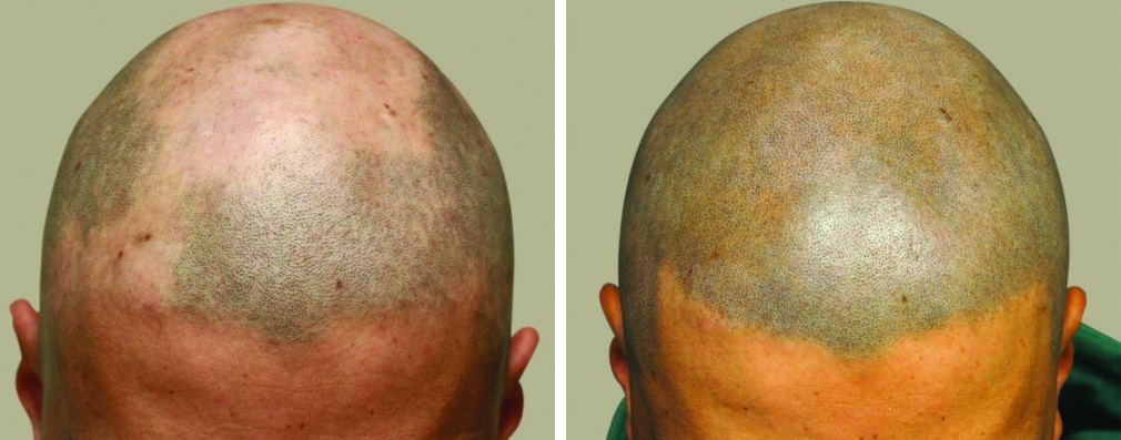 Hair tattoos for men before and after alopecia areata