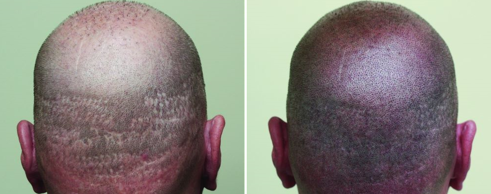 Hair tattoos for men before and after for man with scars and male pattern baldness