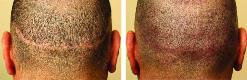 Hair tattoos for men before and after hair transplant scar