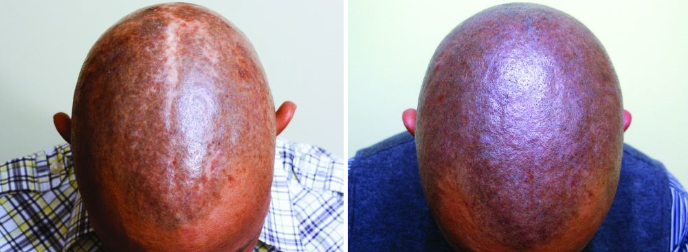 Hair tattoos for men before and after scarring alopecia