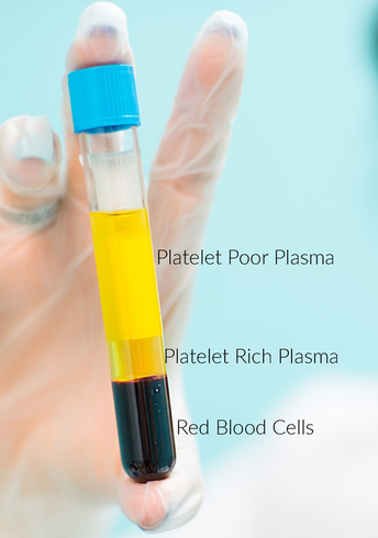 Hand holding a vial of blood separated for PRP extraction