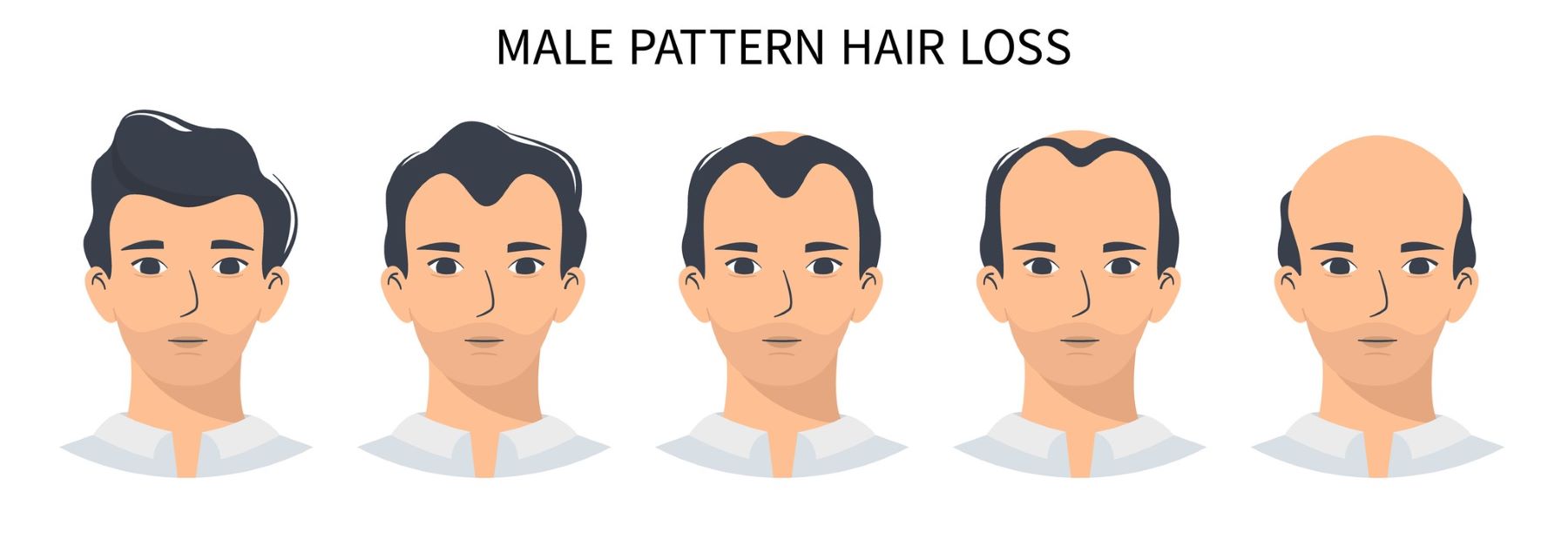 Male hair loss & stages androgenetic alopecia