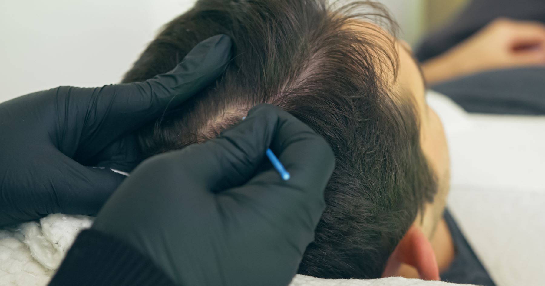 Male hair tattoo combined with hair transplant