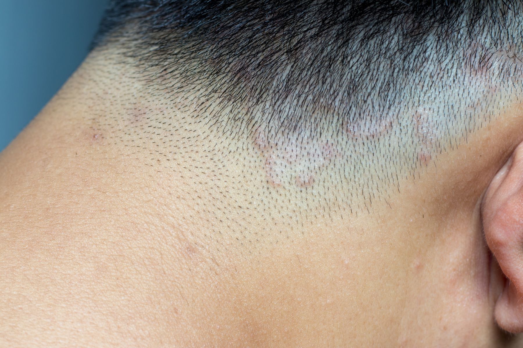 Male patient with tinea capitis (scalp ringworm)
