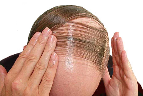 Man combing sparse hair across top bald spot