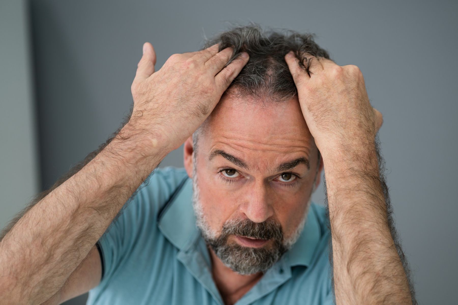 Man considering a forehead hair transplant