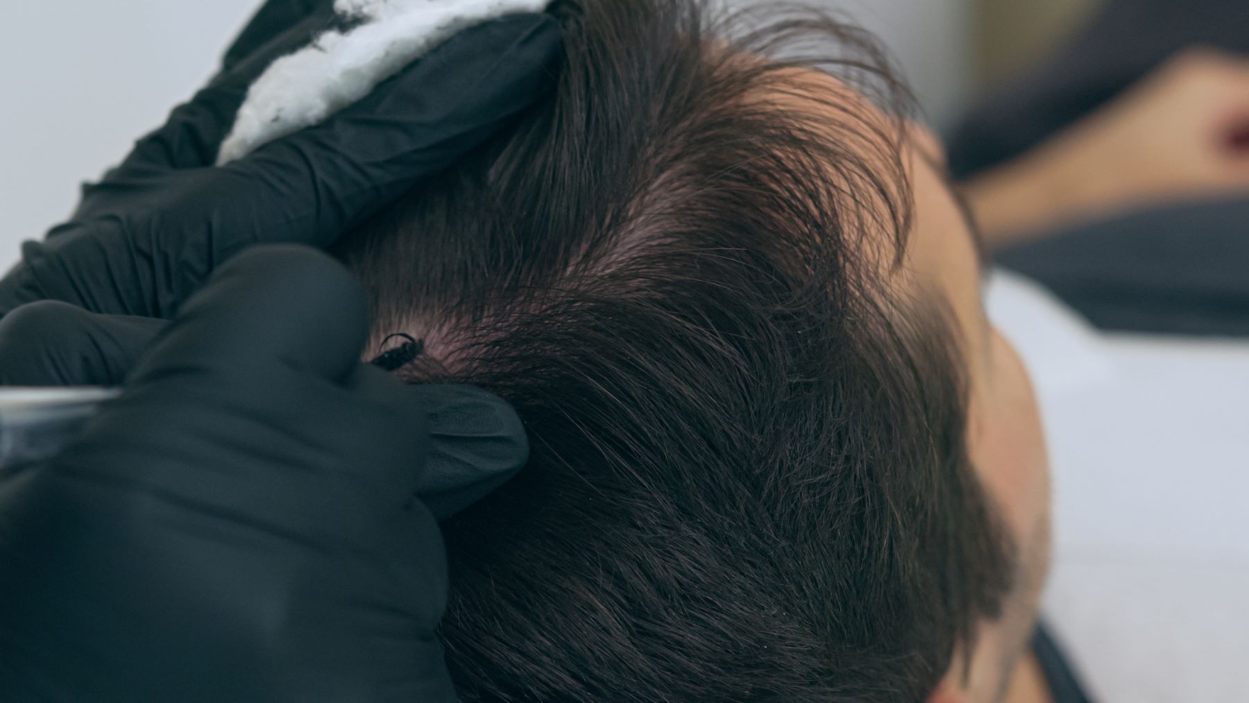 Man getting scalp micropigmentation