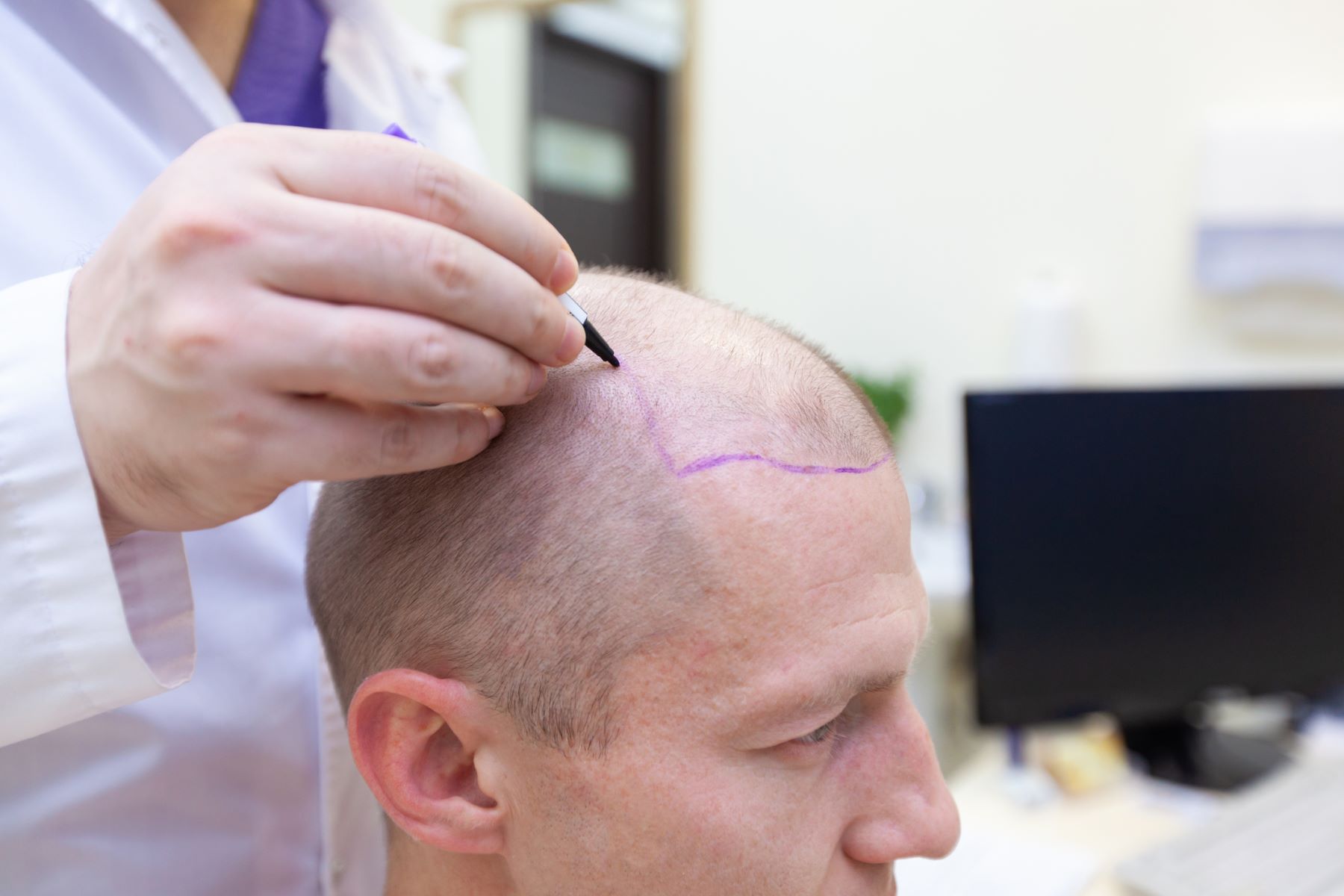 Man preparing for hair transplant surgery