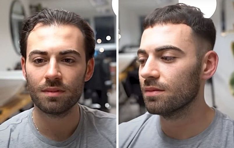 Man with a receding hairline before and after getting a French crop hairstyle
