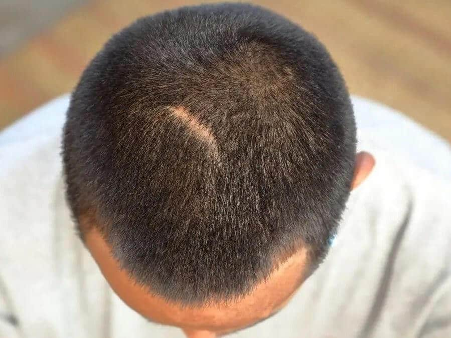 Man with a scar on the top of his head