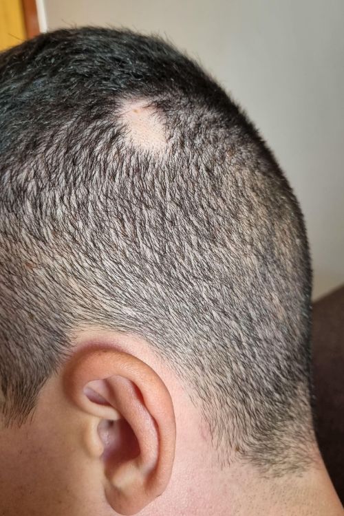 Man with alopecia areata