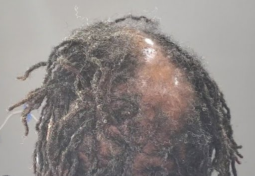 Man with bald spot between thin dreadlocks