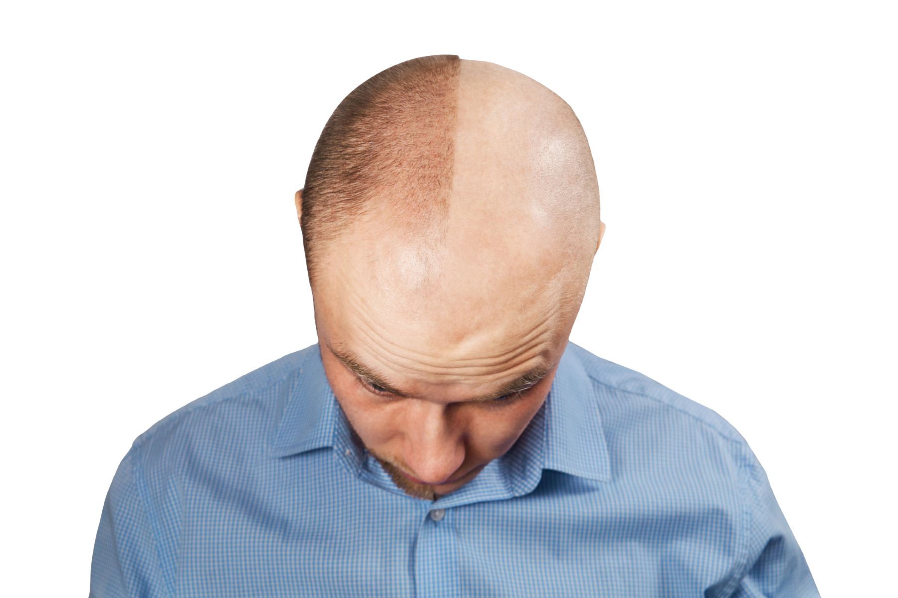 Man with one half of his head growing hair and the other half bald