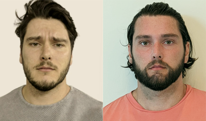 Patient before and after getting a beard transplant