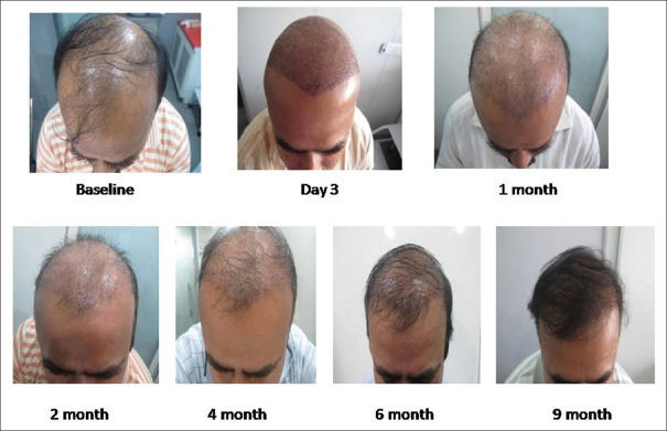 Patient hair growth over 9 months (no PRP)