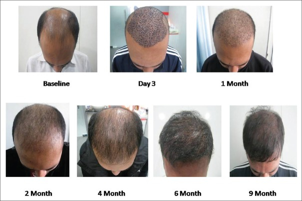 Patient hair growth over 9 months (with PRP)