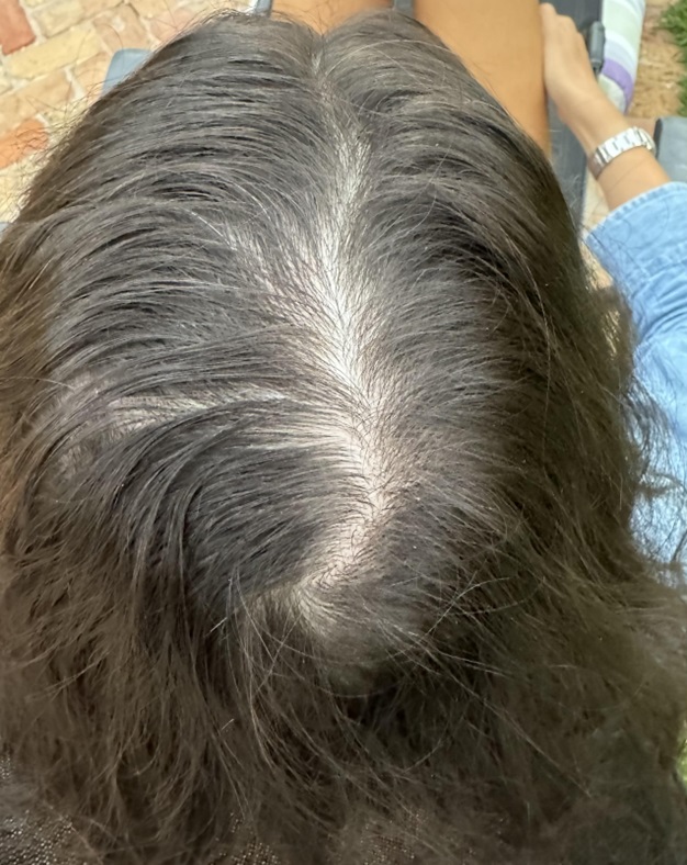 Patient with hair loss caused by weight loss