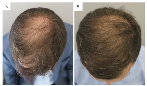 Patient with male pattern baldness after 6 months of PRP therapy